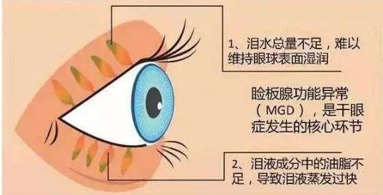 热搜!知名艺人眼睛睑板腺消失,网友炸了:我好像也是