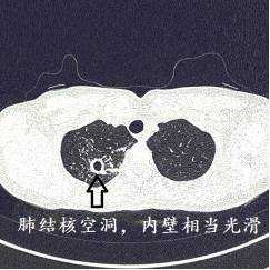 ct诊断肺结核宝典:这是我见过最好的经验总结