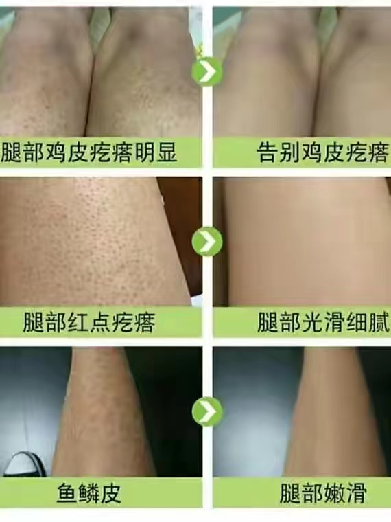 儿童皮炎后鸡皮肤(小儿鸡皮肤怎么治疗)