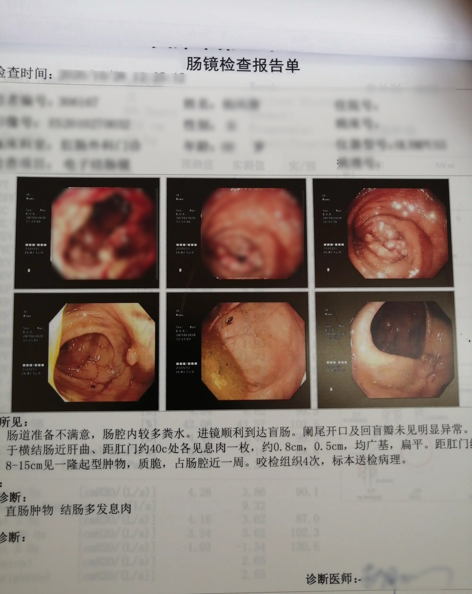 结肠癌早期大便形状图片