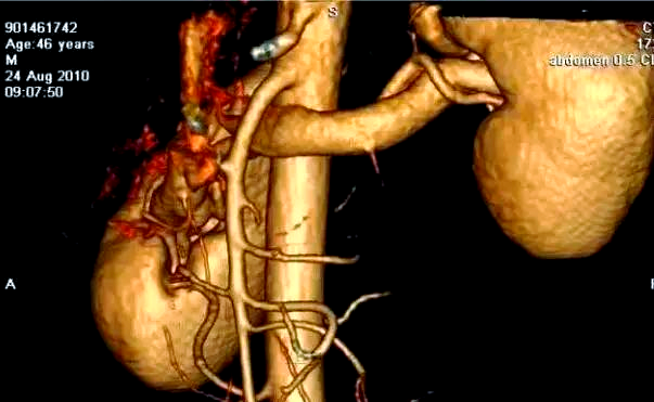 胡桃夹综合征:深入探讨临床表现及治疗方法