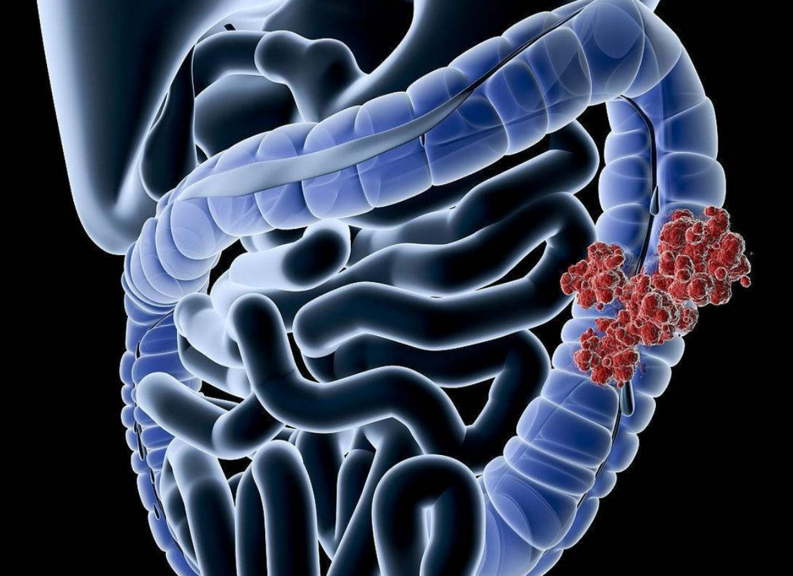 26岁女子"放屁频繁",查出肠癌病变,医生:"一种屁"别忽视