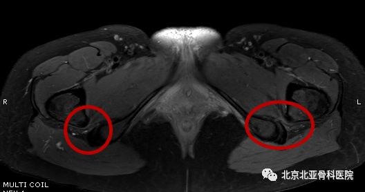 带您了解下什么是坐骨股骨撞击综合征!