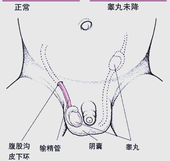 如何识别和治疗隐睾症:家长需知的关键信息