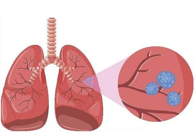 肺息肉图片