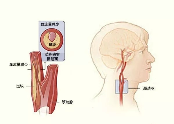 颈动脉和静脉位置图片图片