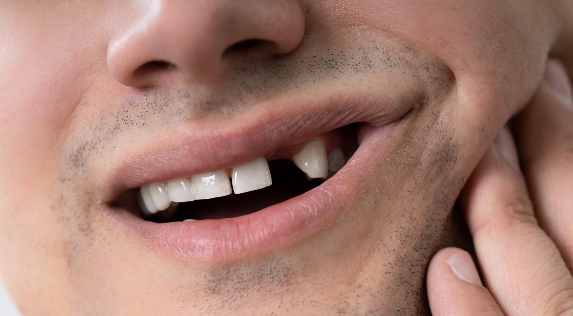 门牙缺失种牙好吗?