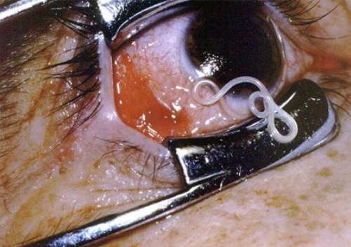 40岁女子生吃螃蟹,感染10种寄生虫,寄生虫病有多可怕?