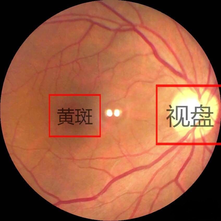 学会看眼底照片图片