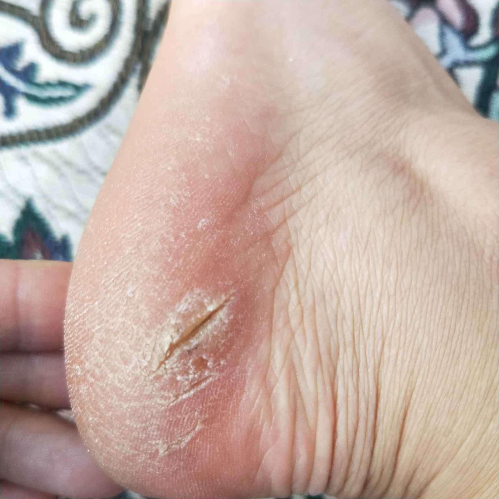 女人脚后跟干裂,死皮厚,怎么办?做好2件事