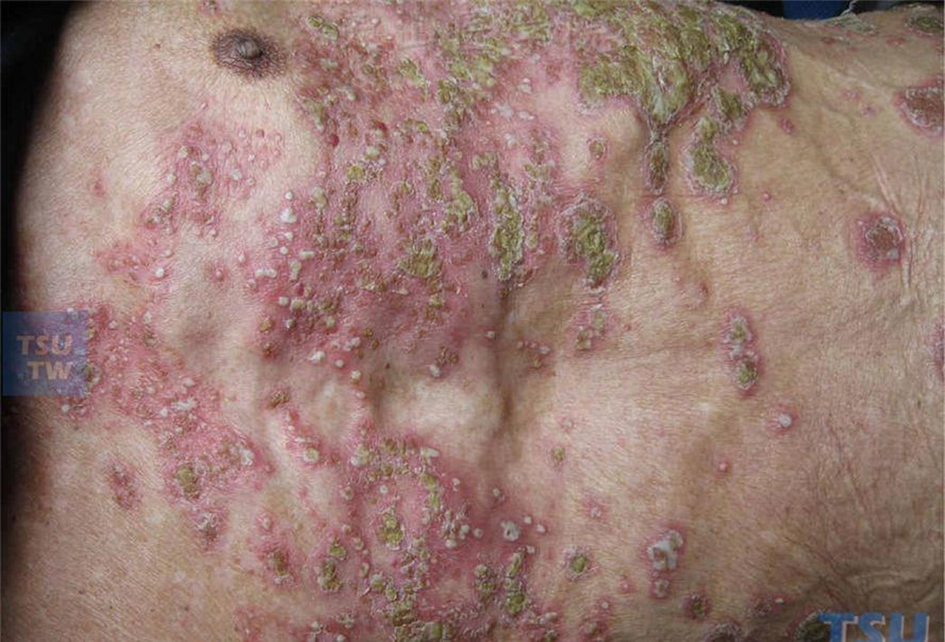 脓疱型银屑病:一般可分为泛发性或掌趾脓疱型银屑病两种.