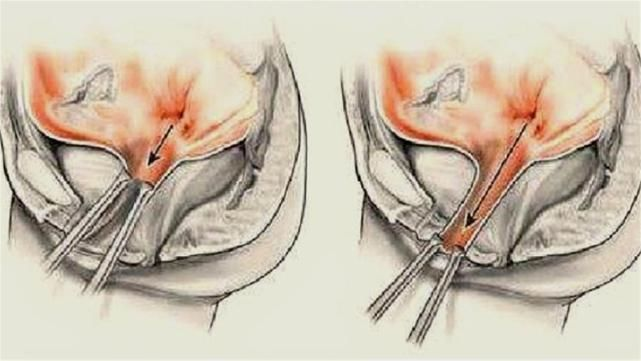 石女和正常人到底有什么区别?