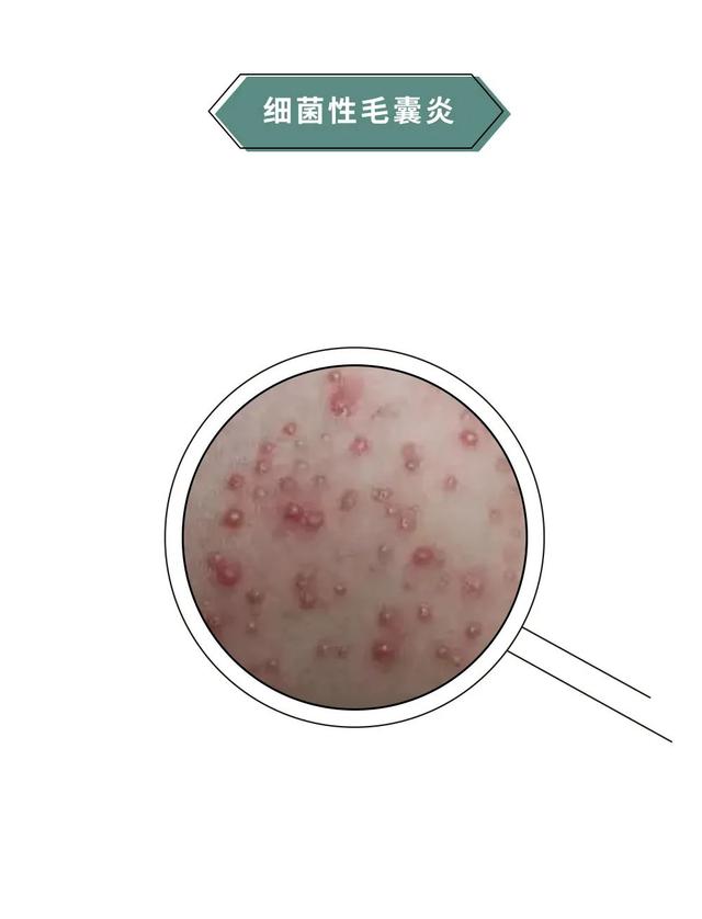 一到夏天背上就长小疙瘩?千万别抠!