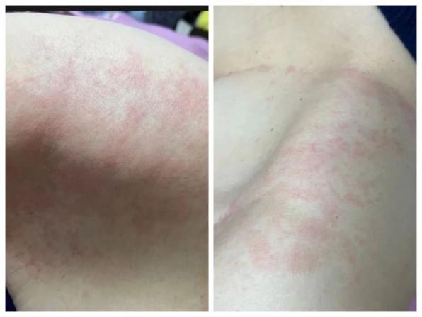 南通多人因服用布洛芬等药后过敏!医生紧急提醒