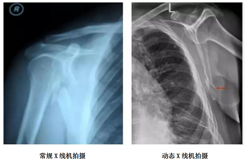 动态dr在复杂体位摄片中的精准高效优势