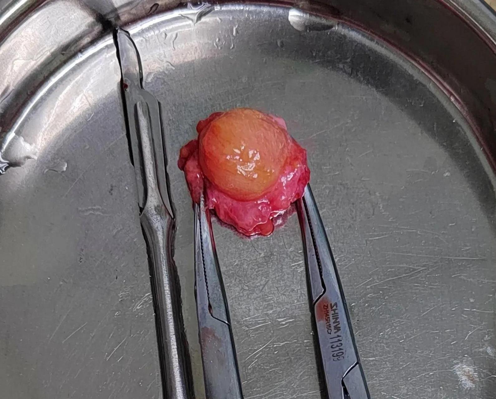 在头皮下 养了10多年 脂肪瘤 终于下定决心 切了!