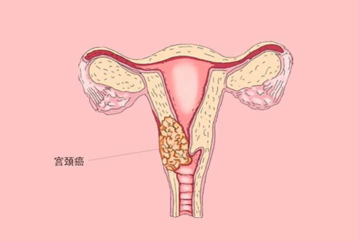 宫颈癌晚期症状与图片图片