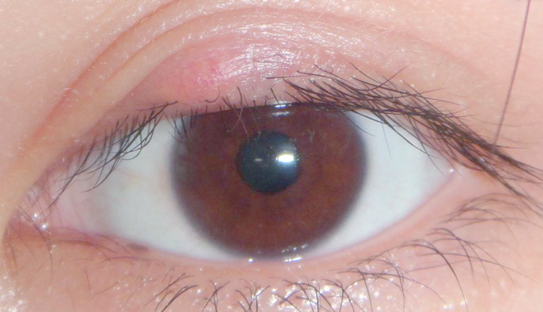 外睑腺炎,也被称为外麦粒肿或睑缘疥,俗称"针眼",是一种由眼睑的皮脂