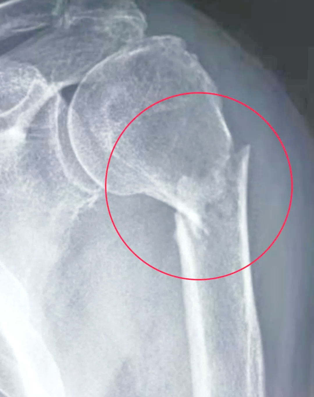 多例骨折治疗前后对比