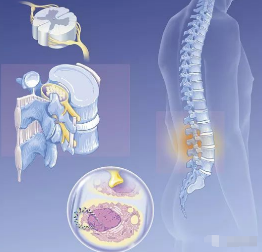 急性脊髓炎的临床表现有哪些