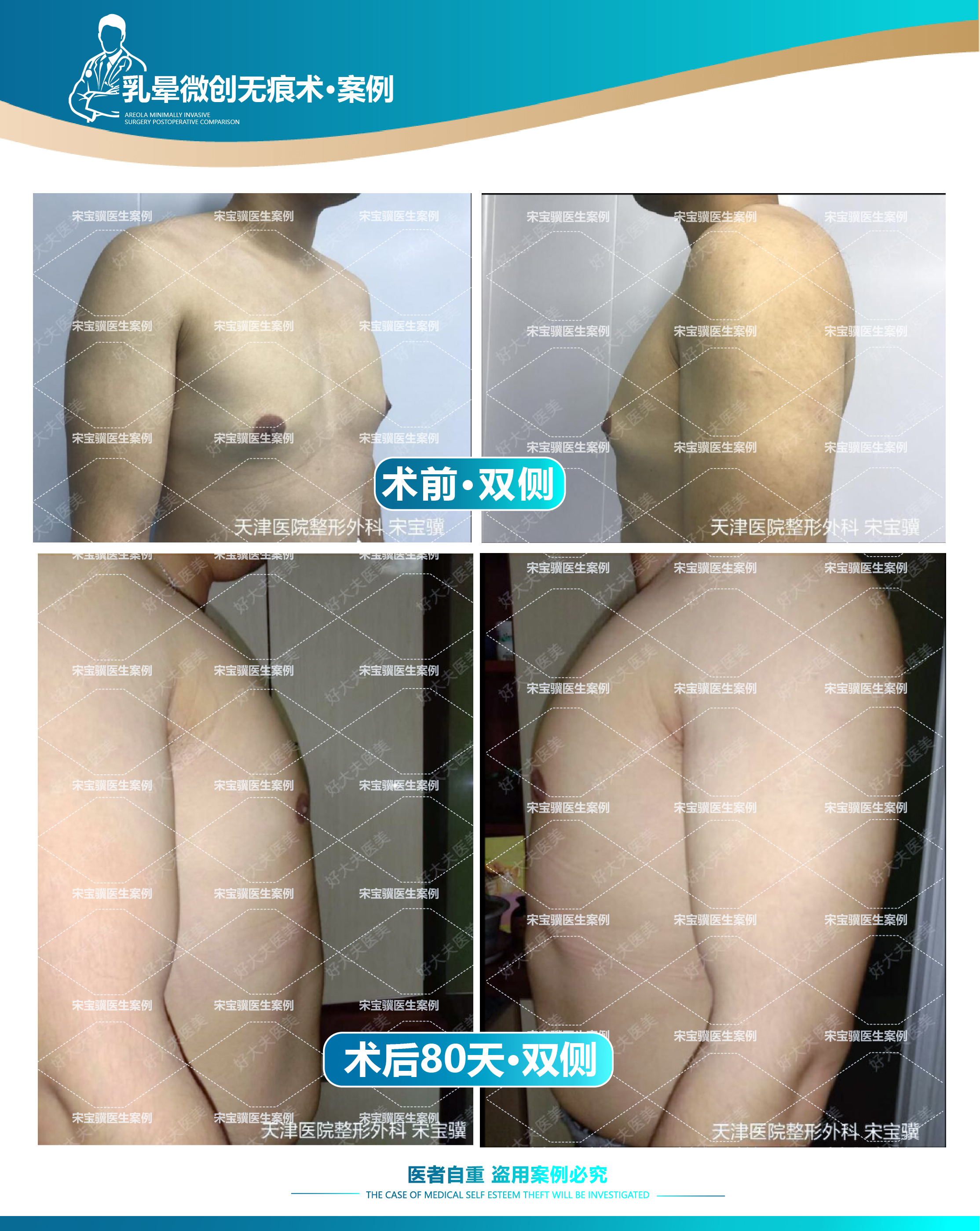 很多有男性乳腺发育症的胸弟都有副乳的困扰,副乳的问题在诊疗的过程