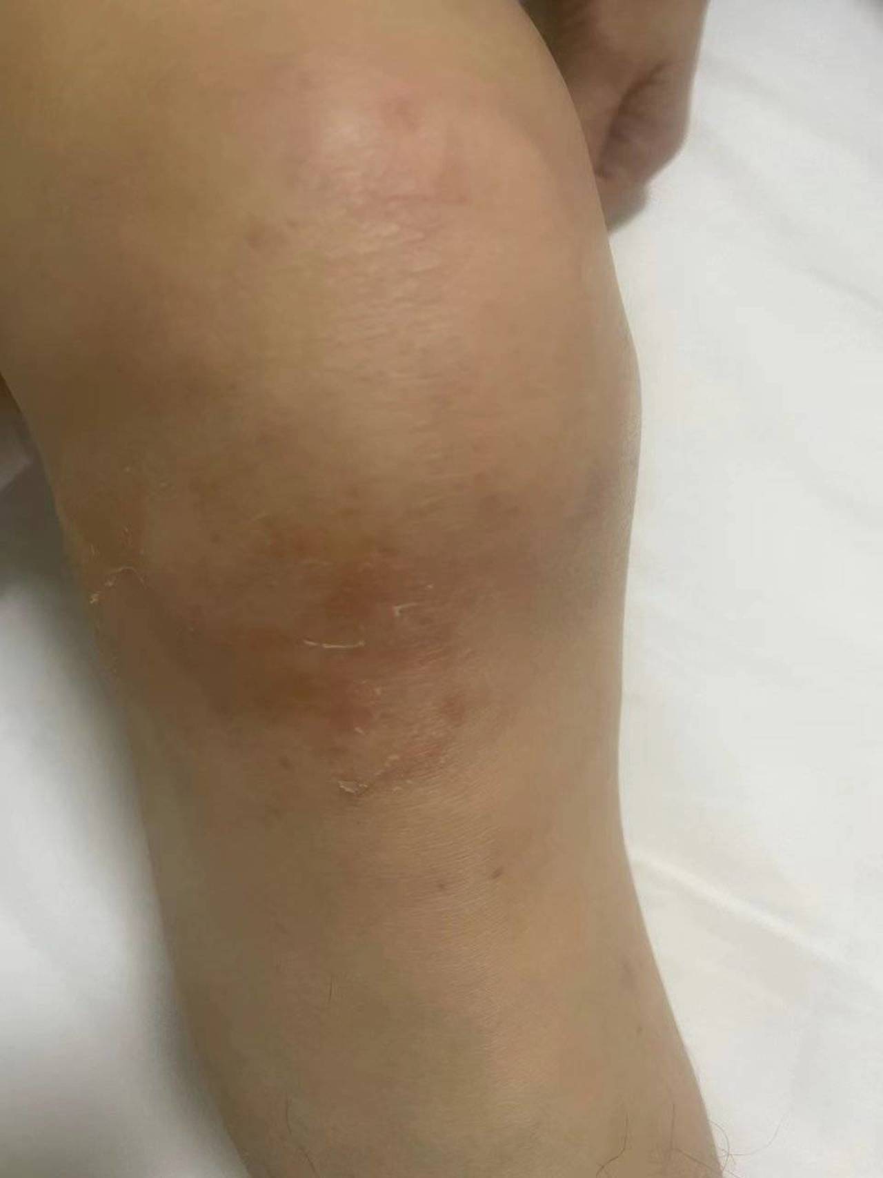 膝盖有积液,担心"越抽越多"?专家:这是常见误解