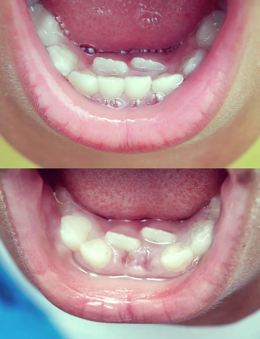 "双排牙",顾名思义,就是指口腔中同一位置出现了两颗牙齿