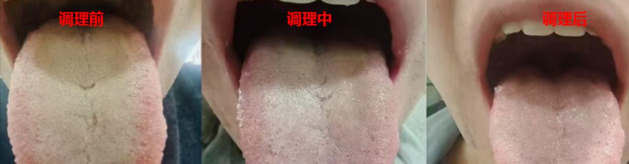 【粉丝舌象:湿热反复,龙胆泻肝丸搭配逍遥丸,结果意想不到】  看到