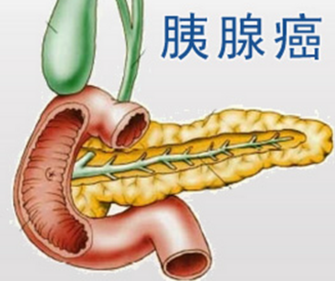 胰腺癌能活多长时间图片