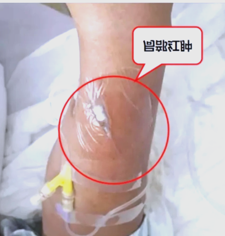 静脉留置针的全面介绍与指南