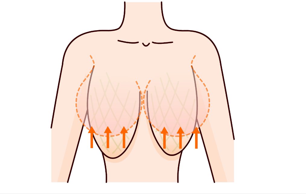 产后下垂口袋胸,不用假体也能变成蜜桃胸吗?