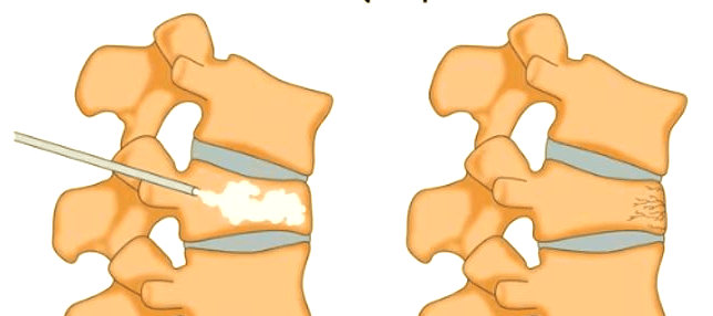 经皮椎体成形术:为老年人提供微创,有效的止痛方案