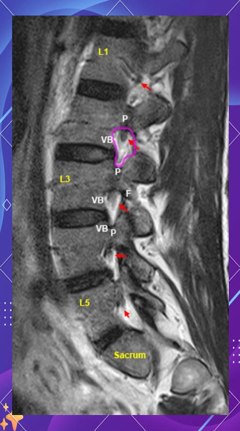 深度解读腰椎mri:从矢状面到横断面的全景扫描