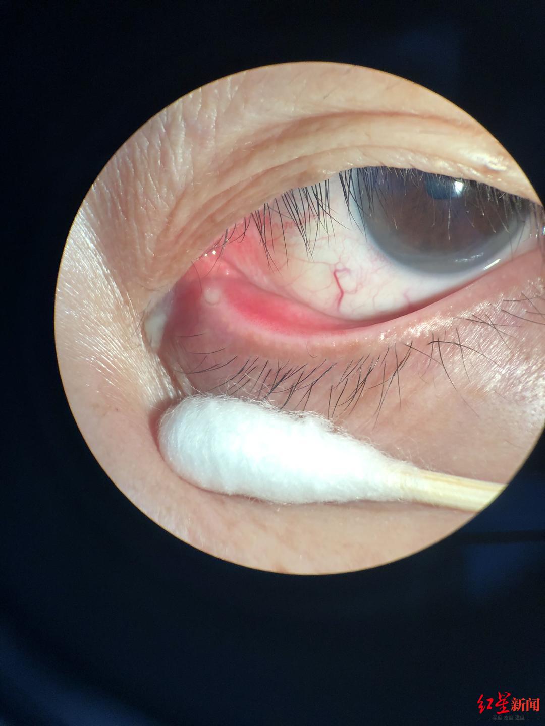 60岁婆婆眼角总是有眼屎 一查竟是眼睛长了结石