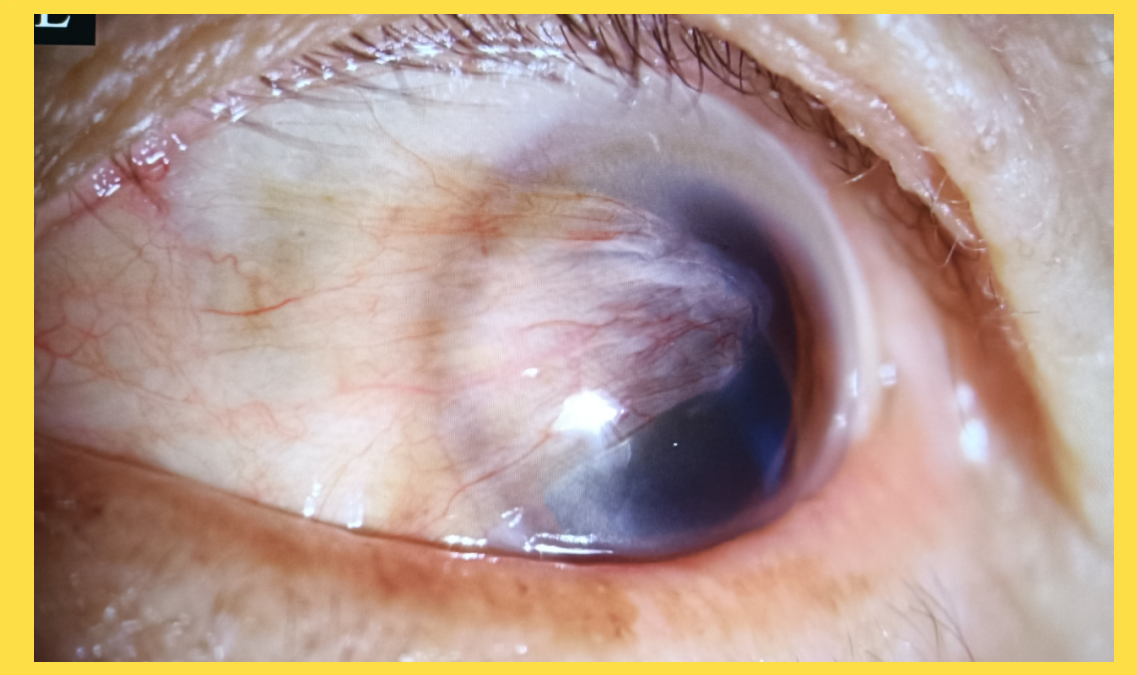 定州市中医医院眼科科普:了解翼状胬肉,保护眼睛健康