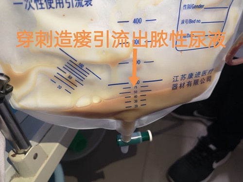 左肾积脓遭遇腰腹壁巨大切口疝,狭路相逢精准穿刺经皮肾造瘘胜