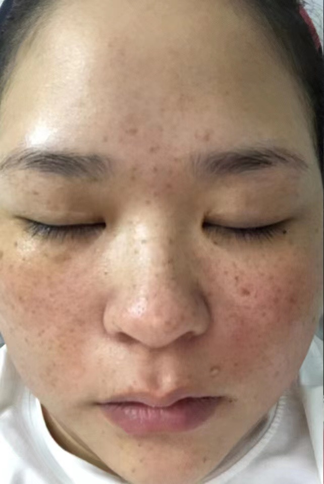 神奇的祛斑原液,有斑人的福音