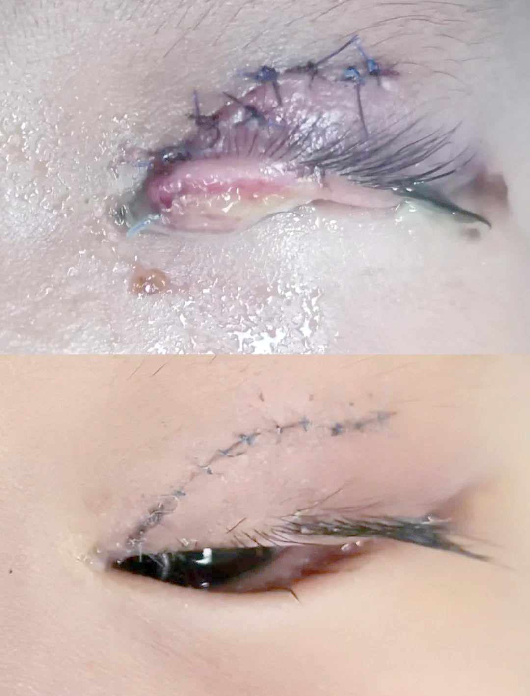 泪小管断裂:一种常见的眼外伤类型