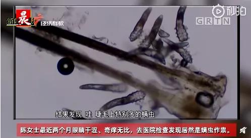 太可怕了!3根睫毛上住着17条螨虫