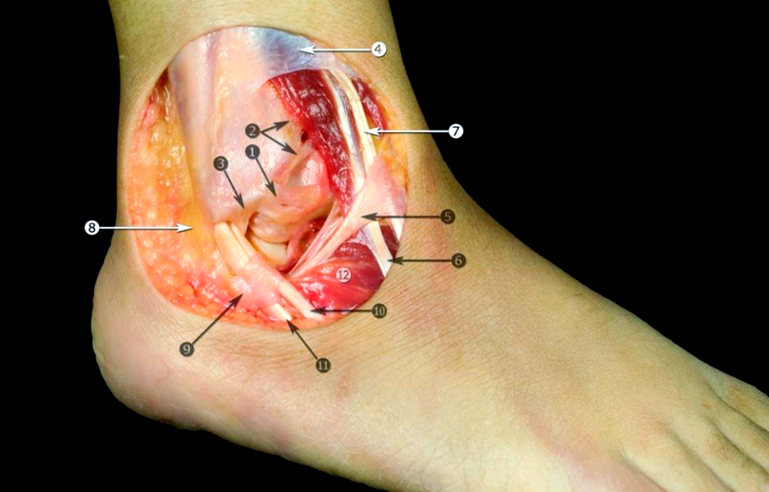 踝关节稳定性的关键,主要包括距腓前韧带,跟腓韧带以及距腓后韧带等