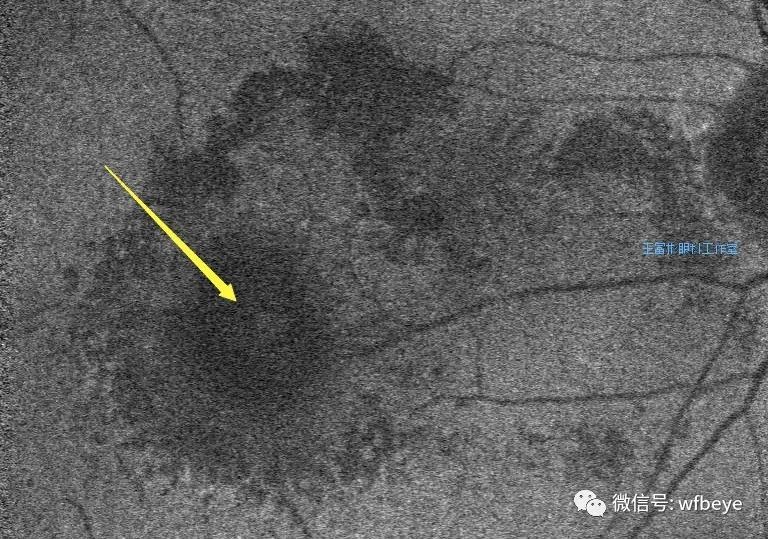 视网膜大动脉瘤(2):它的眼底,oct,自发荧光和icg反射影像特点