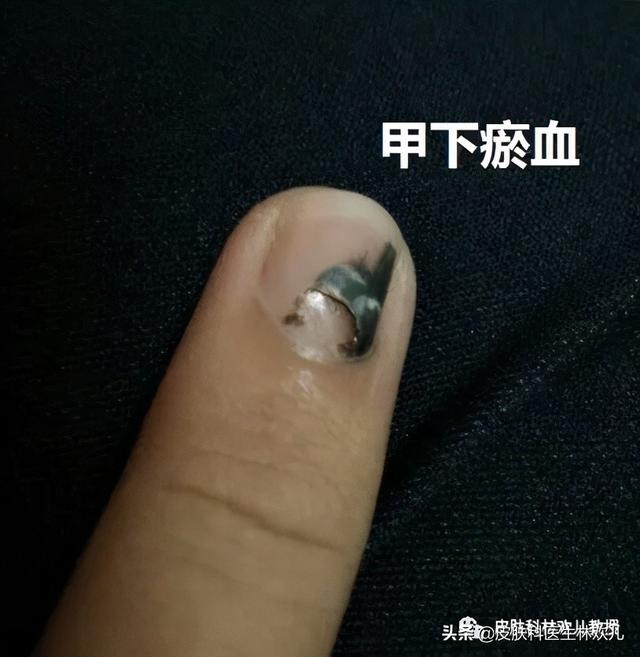 指甲上的黑線竟然是