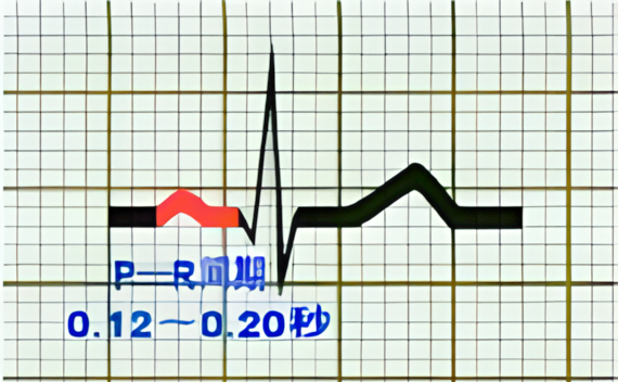 心电图中的pr间期解读:心脏传导的晴雨表