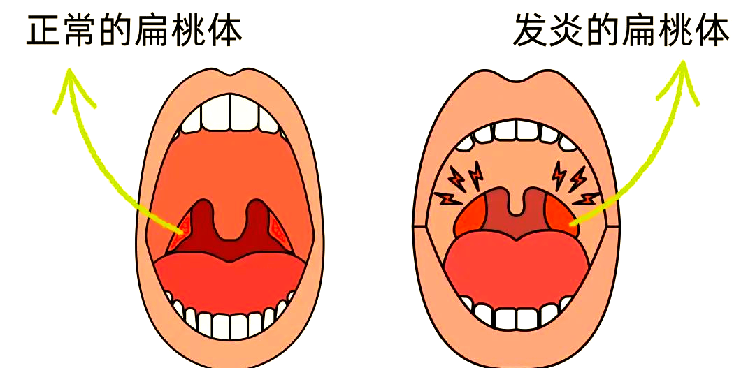 秋季扁桃体炎高发,多种有效方法助你应对