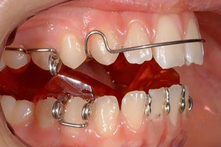 直丝弓矫治器的创新与发展:个性化选择的策略