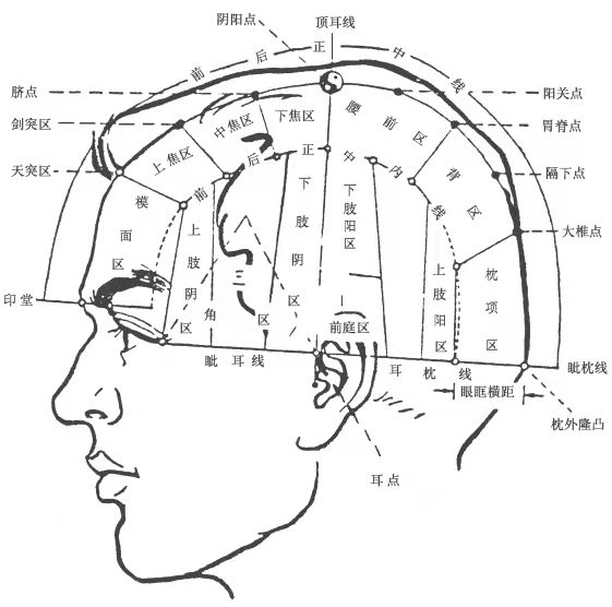 中枢性疼痛怎么办?不如试试头皮针