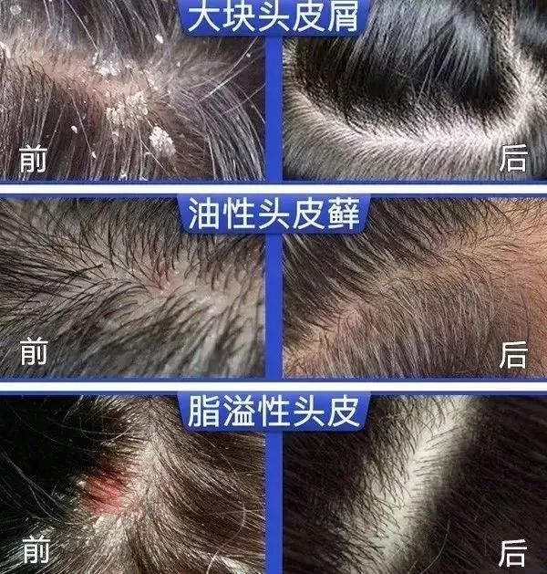 「密丝麦莎」头上扣下来的白泥竟然是螨虫尸体!