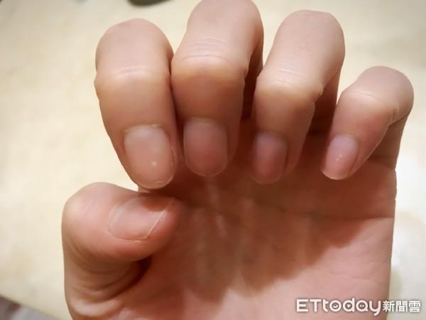 指甲月牙不明显就是生病?医曝透明小皮才是关键:千万别刮掉