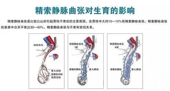 哪種精索靜脈曲張需要手術?有哪些手術方法?