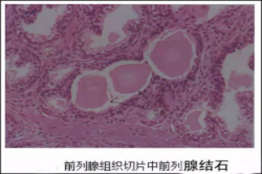 前列腺淀粉样小体图片